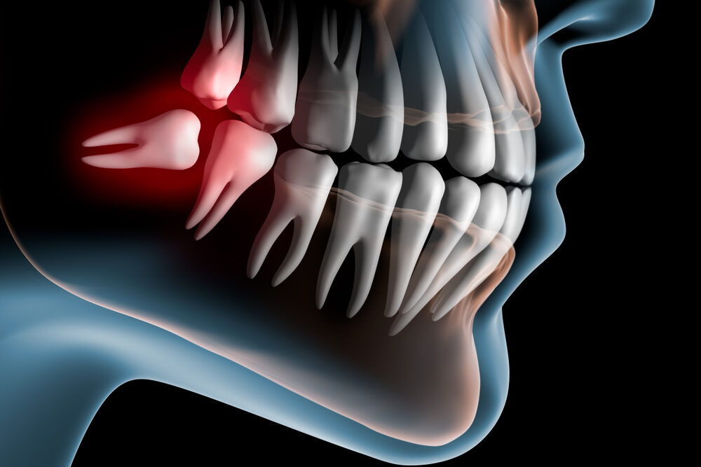 Why Do Teeth Fall Out?